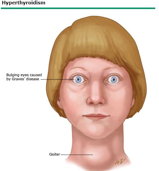 Figura de hipertiroidismo
