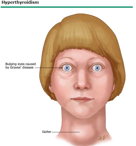 Hyperthyroidism Figure