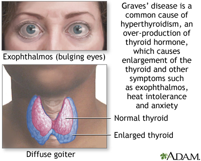 Graves’ Disease